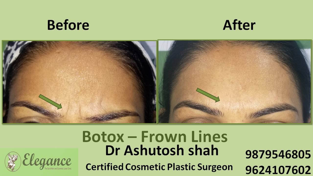 Glabellar Frown Lines Botox Treatment In Surat Gujarat India 3038