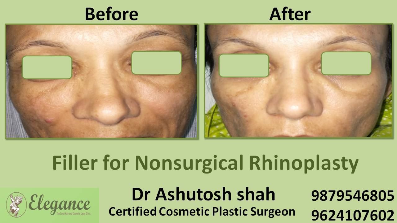 Filler For Nonsurgical Rhinoplasty Doctor In Surat, Gujarat, India