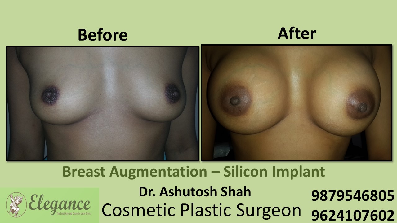 Breast Augmentation Treatment, Navsari, Gujarat, India.