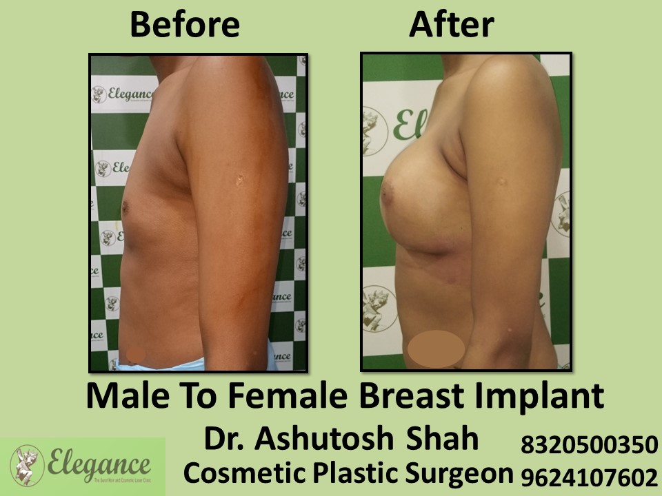 Male to Female Breast Implant Surgery in Vesu, Surat
