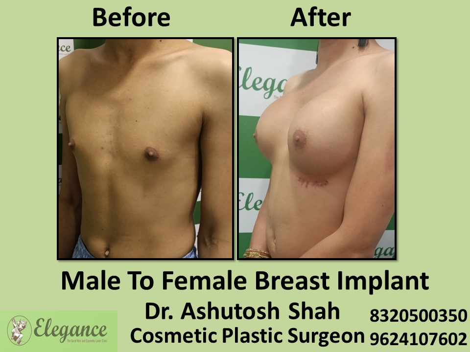 Male to Female Breast Implant Surgery in Piplod, Athwagate, Surat
