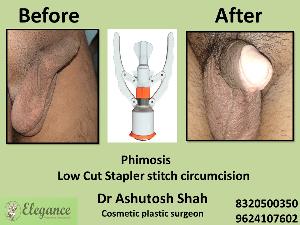 Phimosis Circumcision Surgery in Aligarh, Phimosis Treatment in UP