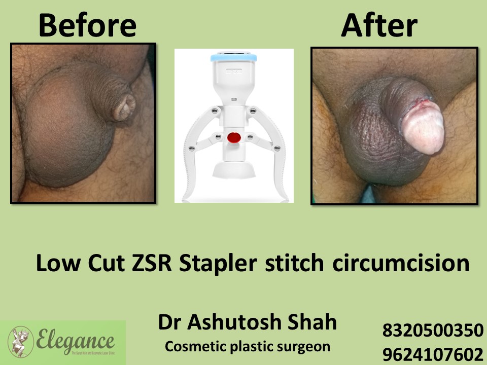 Low cut ZSR stapler stitch circumcision in Bharuch, Surat, Gujarat