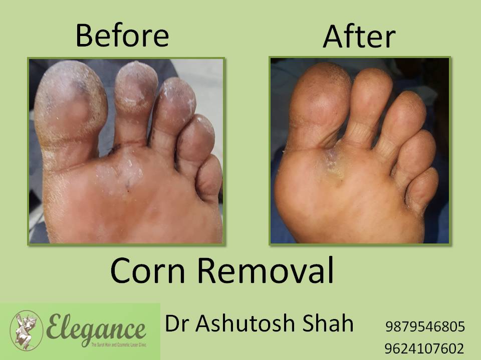 Foot Ulcers and Corn  Corn Removal Treatment in Kolkata