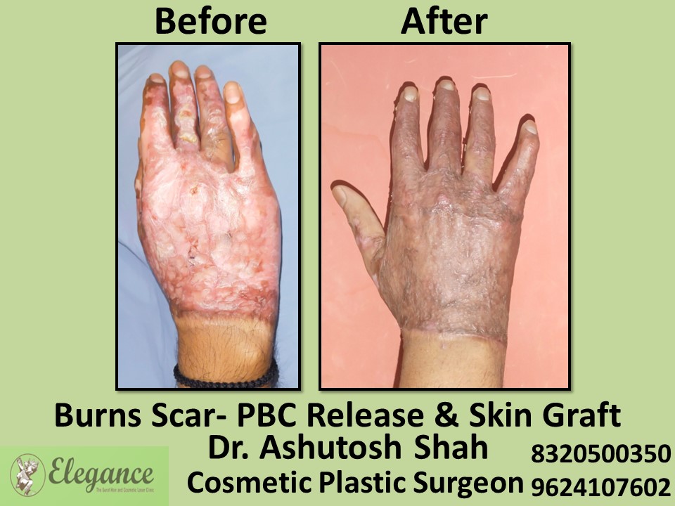 Burn Scar, Co2 Laser Treatment, Skin Graft  in Vesu, Piplod, Surat