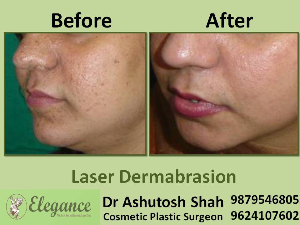 Laser Dermabrasion Treatment In Surat, Gujarat, India