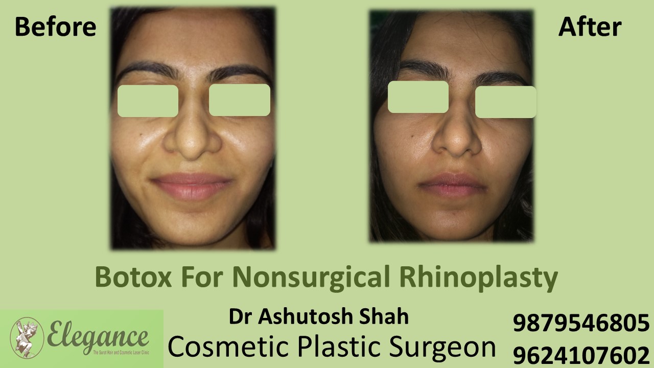 Liquid Rhinoplasty