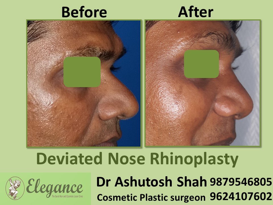 Best Doctor for Nose Surgery, Rhinoplasty in Surat, Gujarat