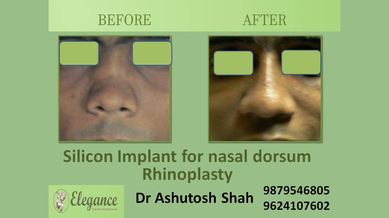 Silicone Implant For Nose