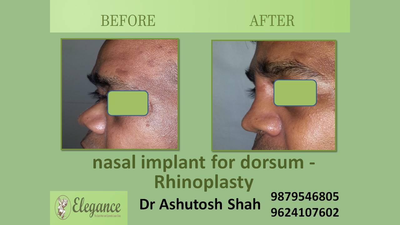 Nasal Dorsum Correction