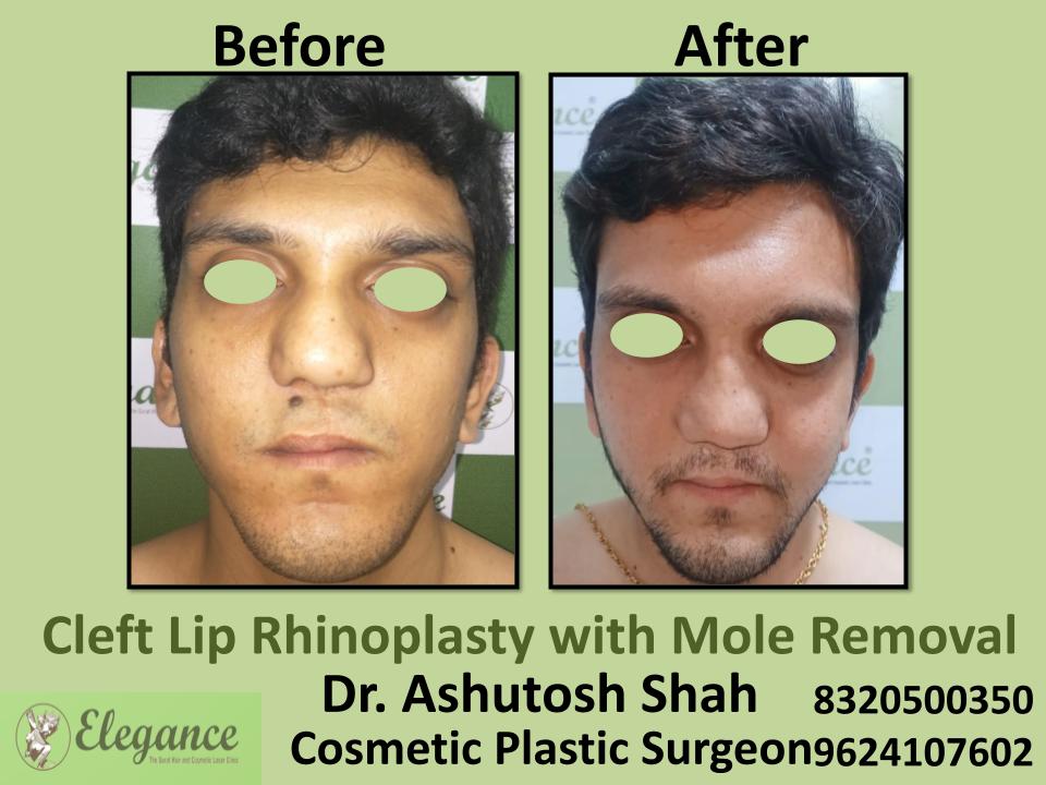 Maxillary Advancement Using Rib Graft With Rhinoplasty, Nose Reshaping With  Advancing Methods, Bhatar, Ghod Dhod, Vesu, Surat, Gujarat.