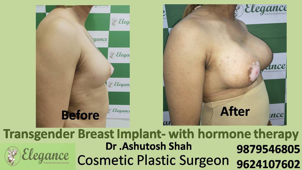 TransGender Breast Implant MTF Vadodara Gujarat India