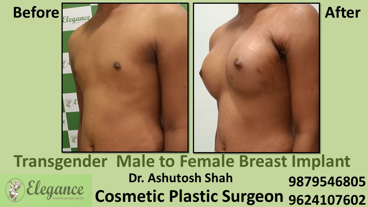 Transgender Breast Augmentation Surgery