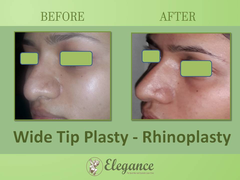 Wide Tip Plasty Surgery in Vadodara, Gujarat, India.